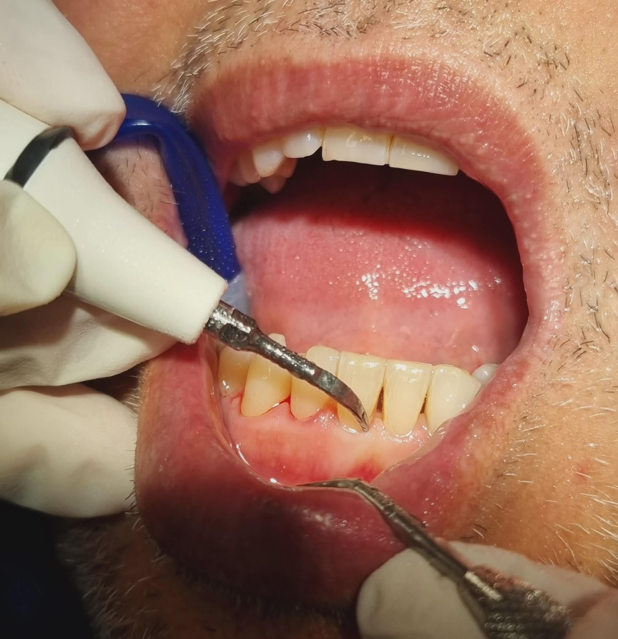 Igiene Dentale Professionale